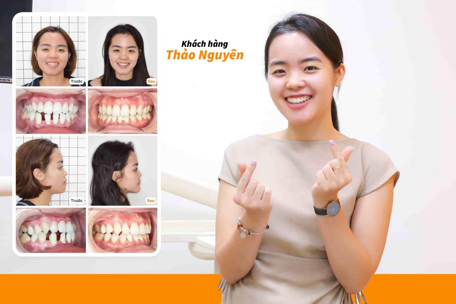 Hình ảnh niềng răng mắc cài kim loại của Khách hàng Thảo Nguyên