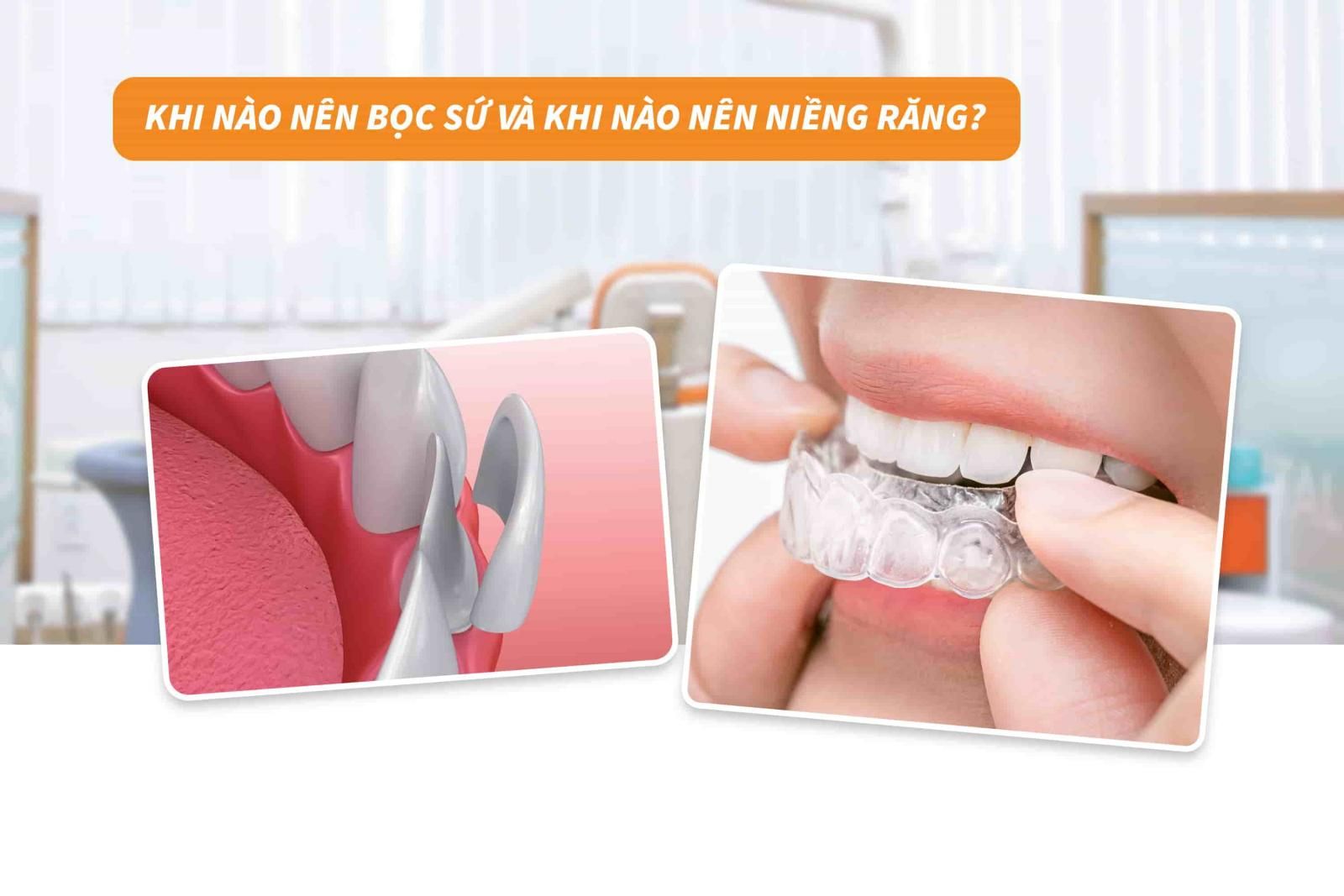 Khi nào nên bọc sứ và khi nào nên niềng răng