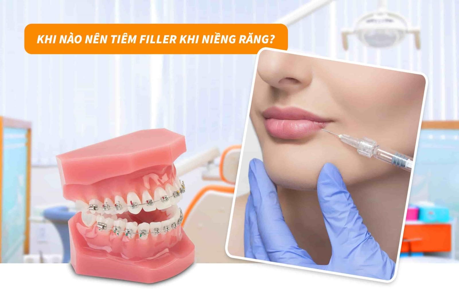 Khi nào nên tiêm filler khi niềng răng?