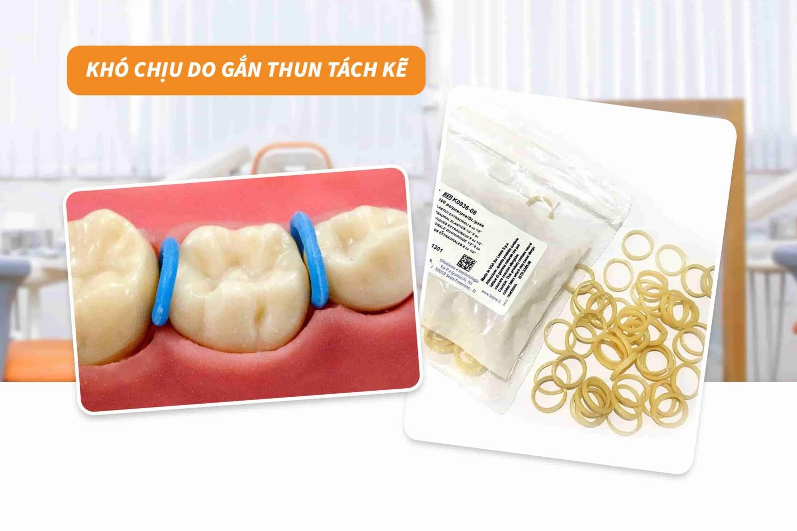 Khó chịu do gắn thun tách kẽ