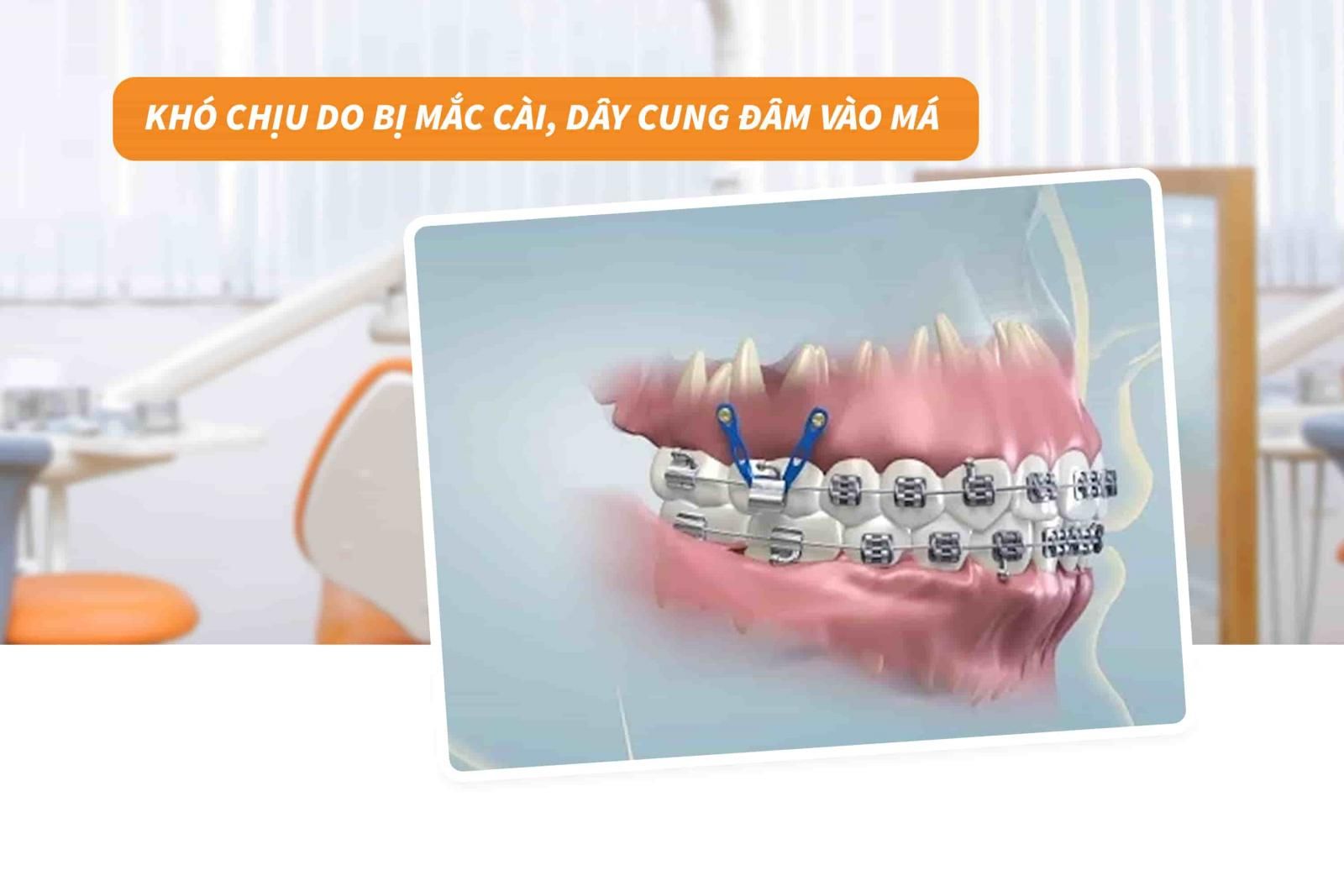 Khó chịu do mắc cài, dây cung đâm vào má