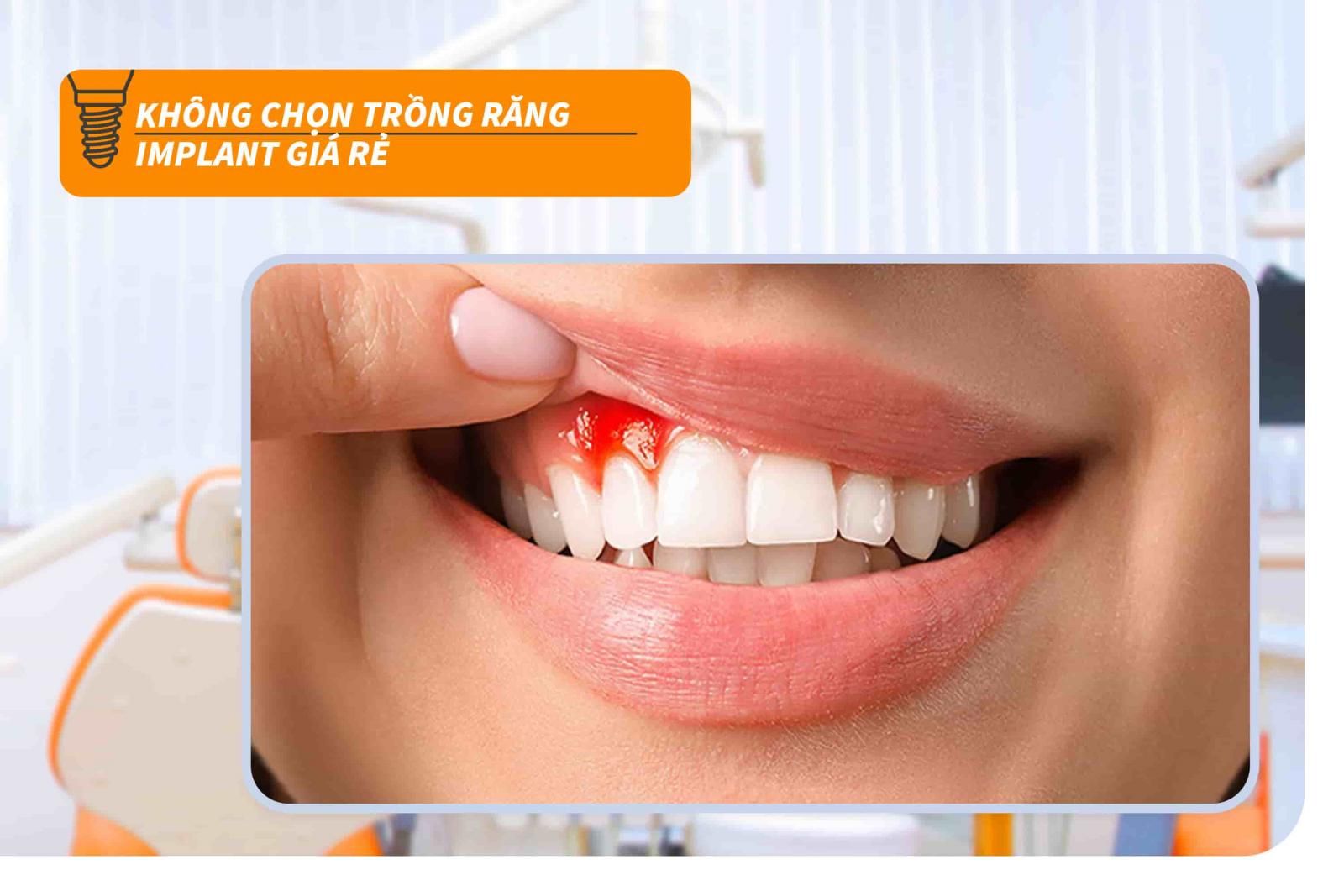 Không chọn trồng răng Implant giá rẻ