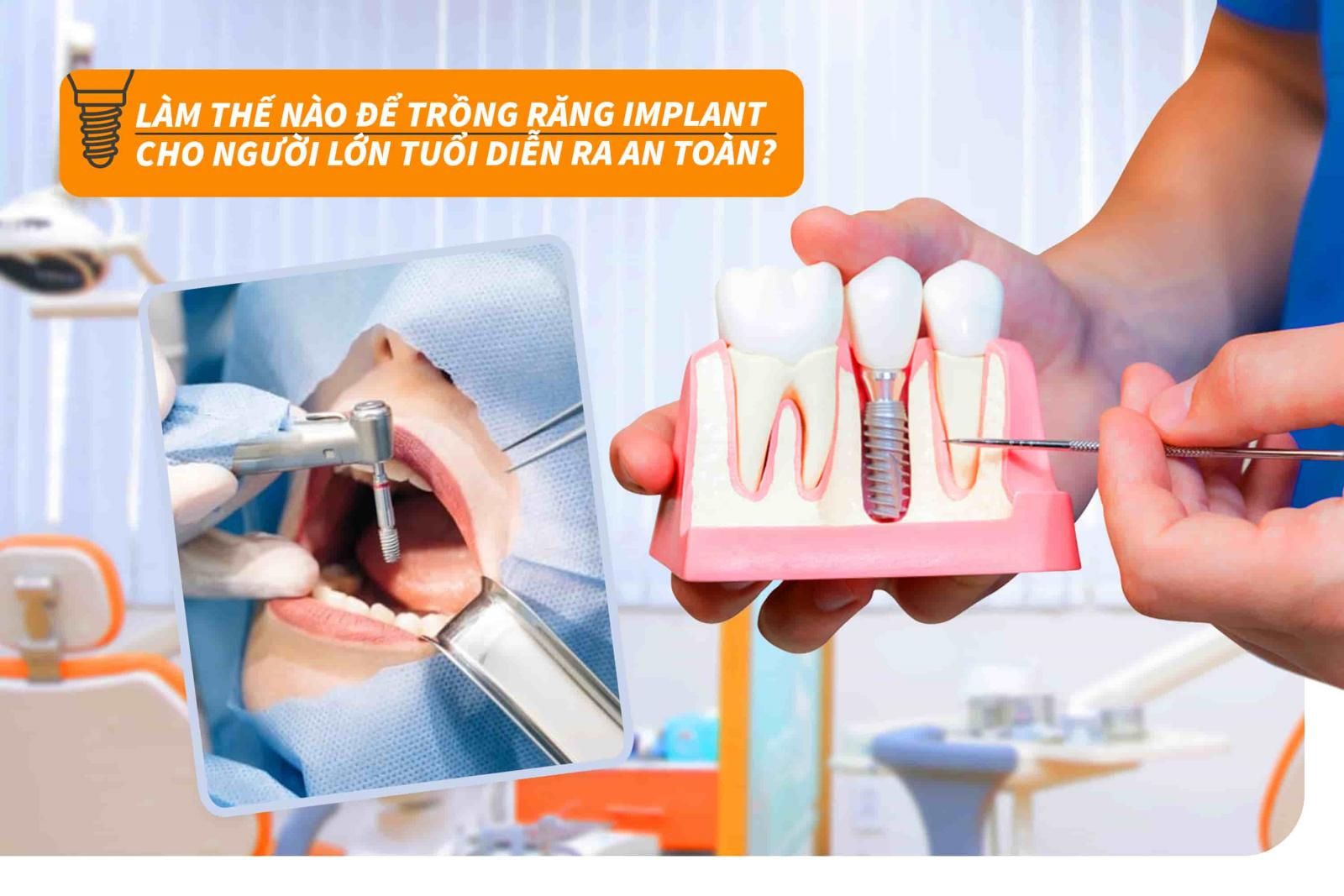 Làm thế nào để trồng răng Implant cho người lớn tuổi diễn ra an toàn