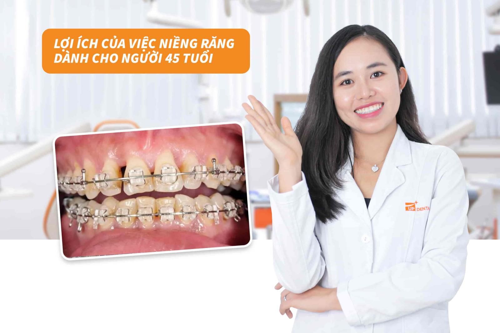 Lợi ích của việc niềng răng dành cho người 45 tuổi