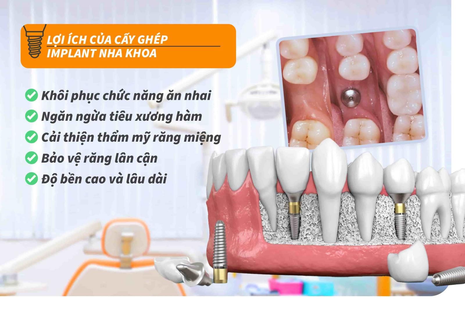 Lợi ích của cấy ghép Implant chuẩn Y khoa