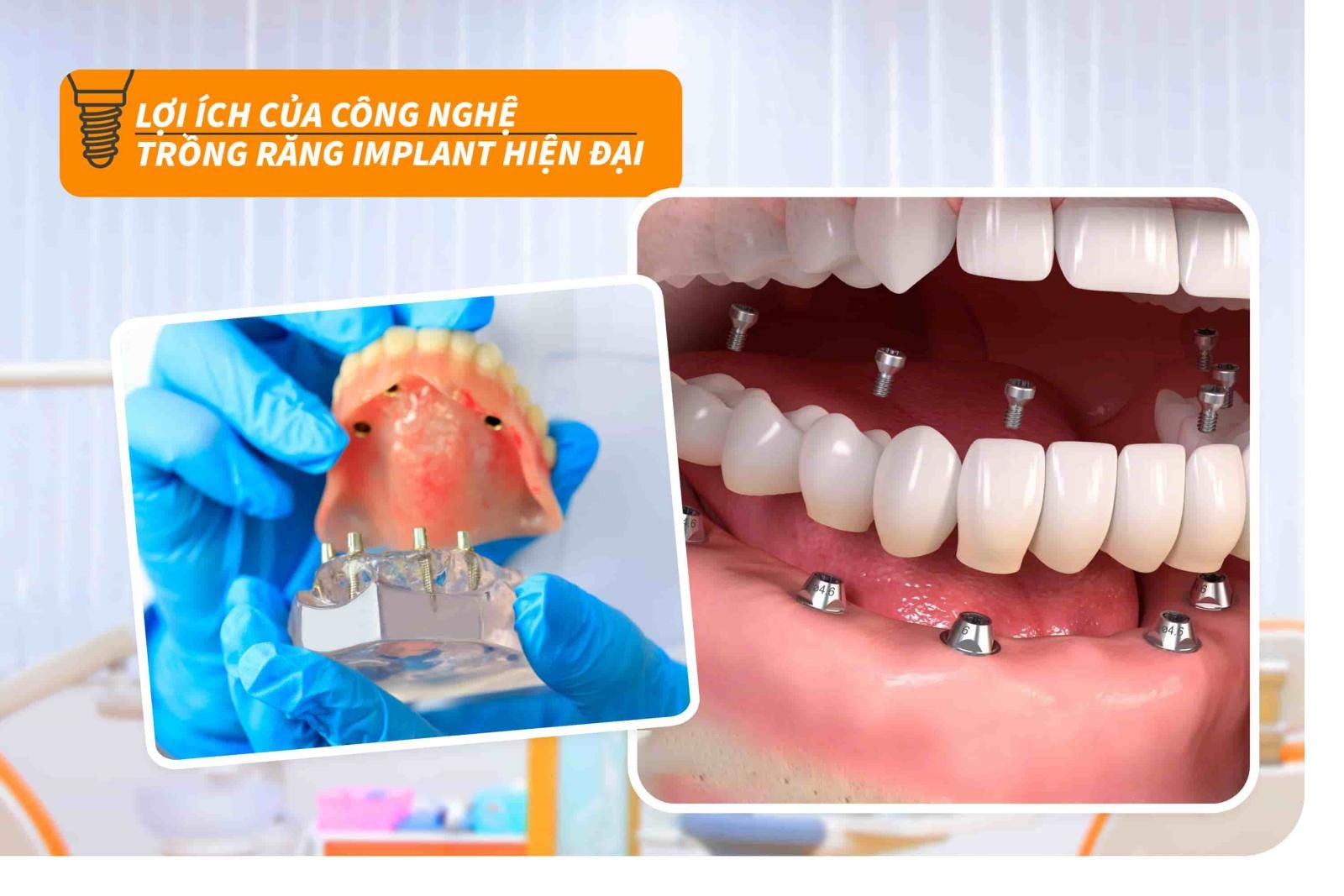 Lợi ích của công nghệ trồng răng Implant hiện đại