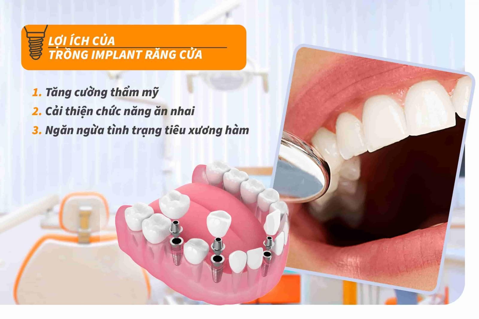 Lợi ích của trồng Implant răng cửa