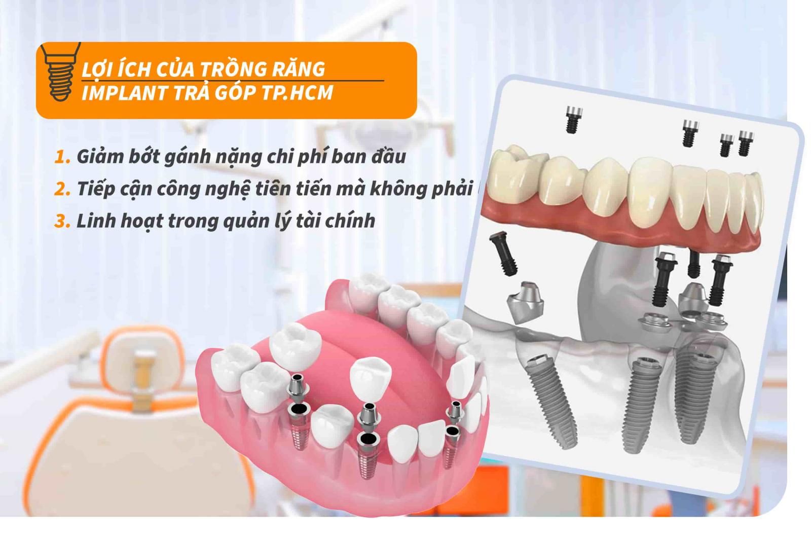 Lợi ích của trồng răng Implant trả góp TP.HCM