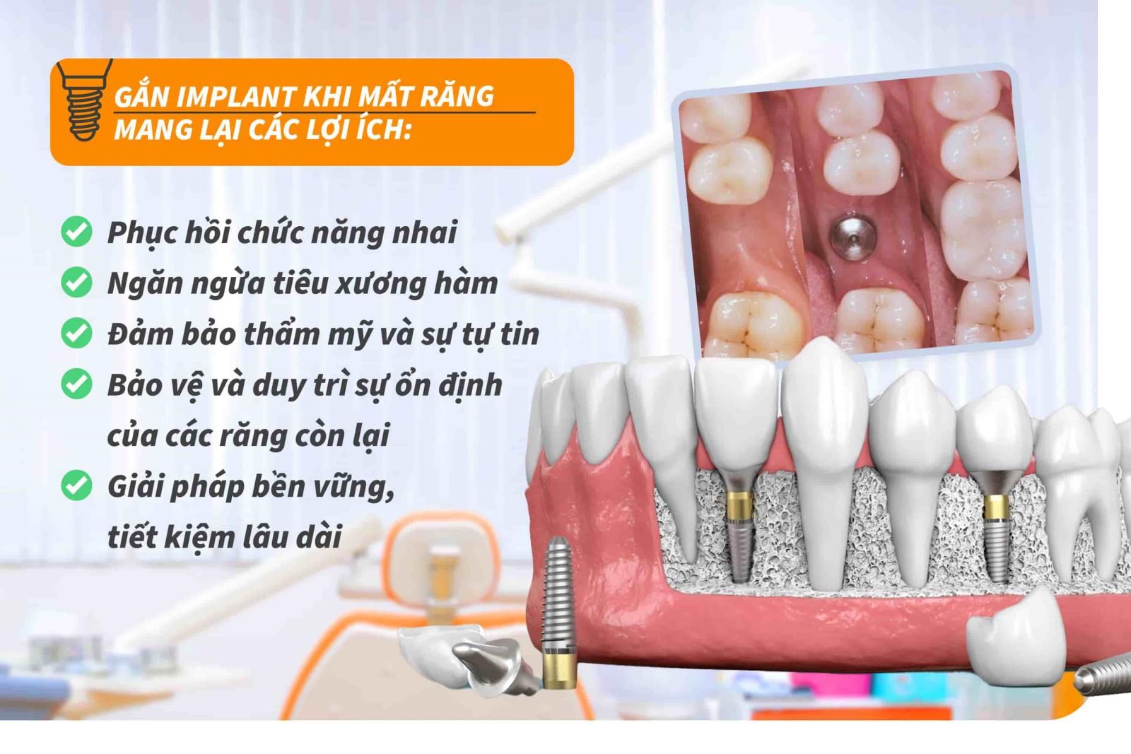 Tại sao phải gắn Implant khi mất răng?