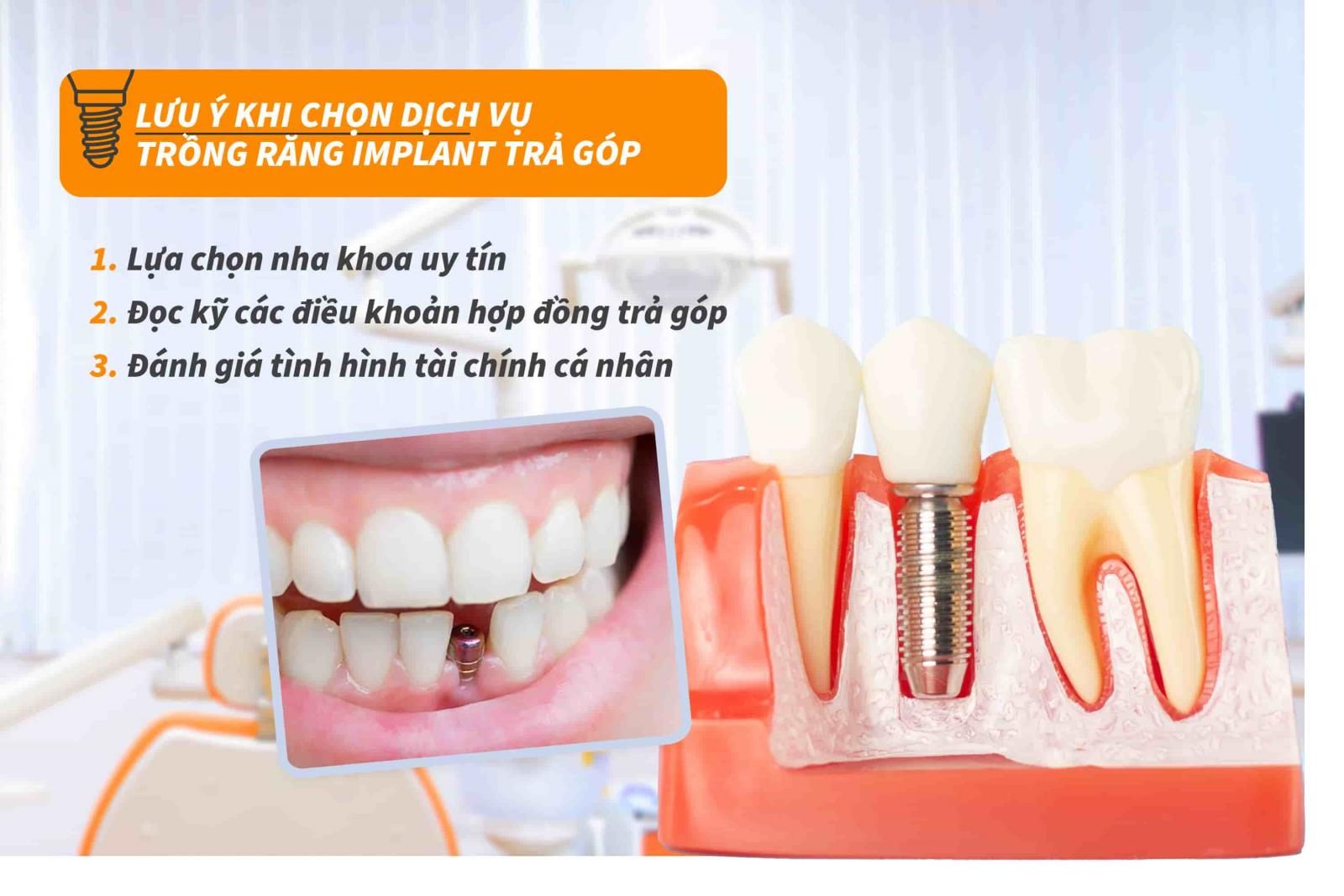 Lưu ý khi chọn dịch vụ trồng răng Implant trả góp