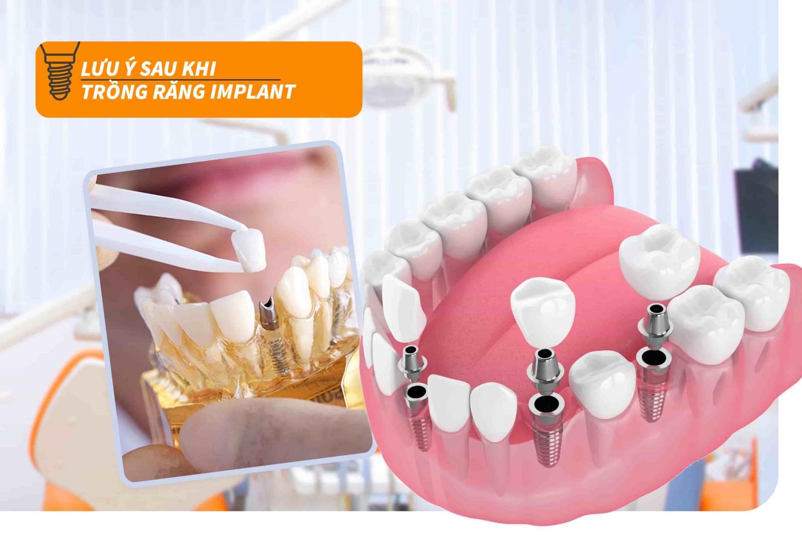 Lưu ý sau khi trồng răng Implant