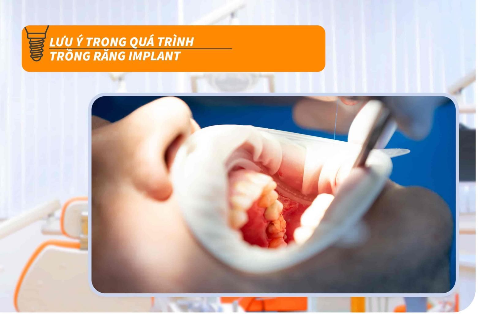 Lưu ý trong quá trình trồng răng Implant