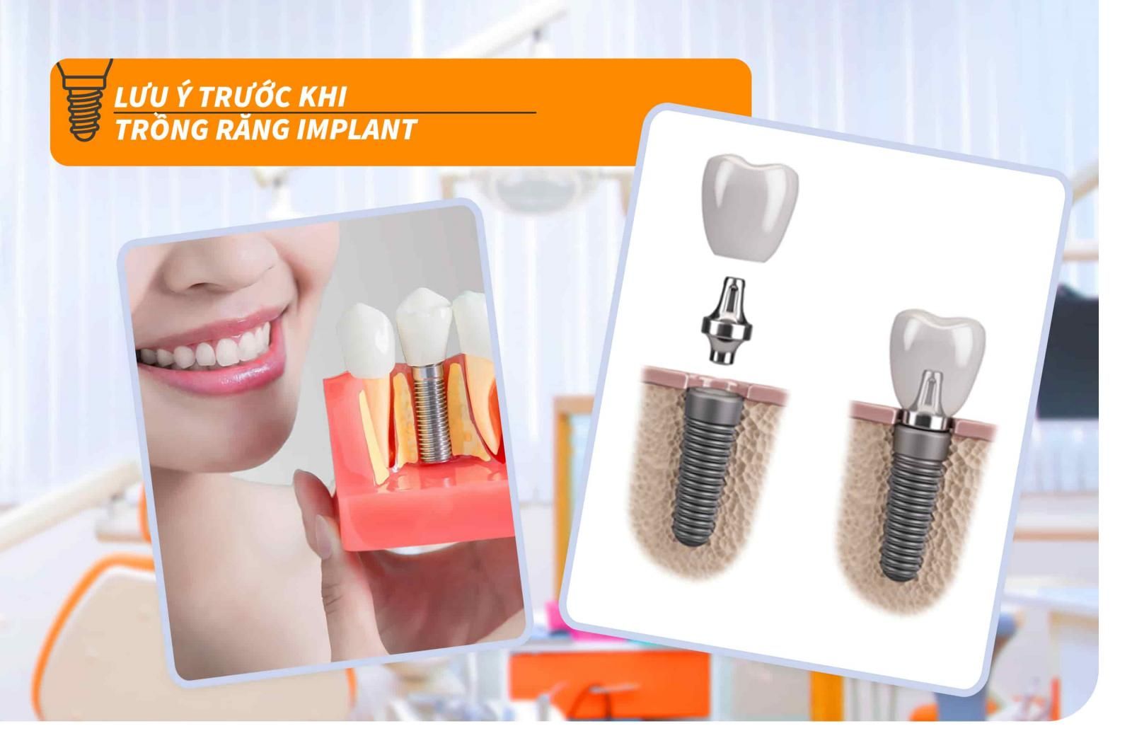 Lưu ý trước khi trồng răng Implant