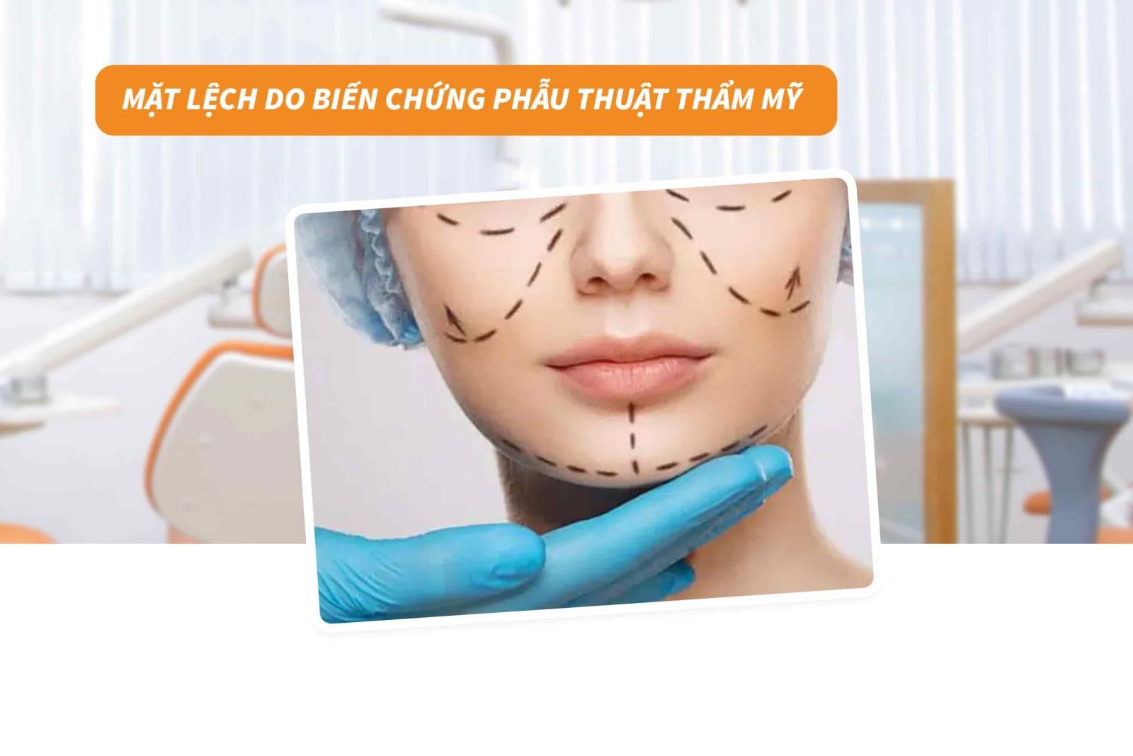 Mặt lệch do biến chứng của phẫu thuật thẩm mỹ