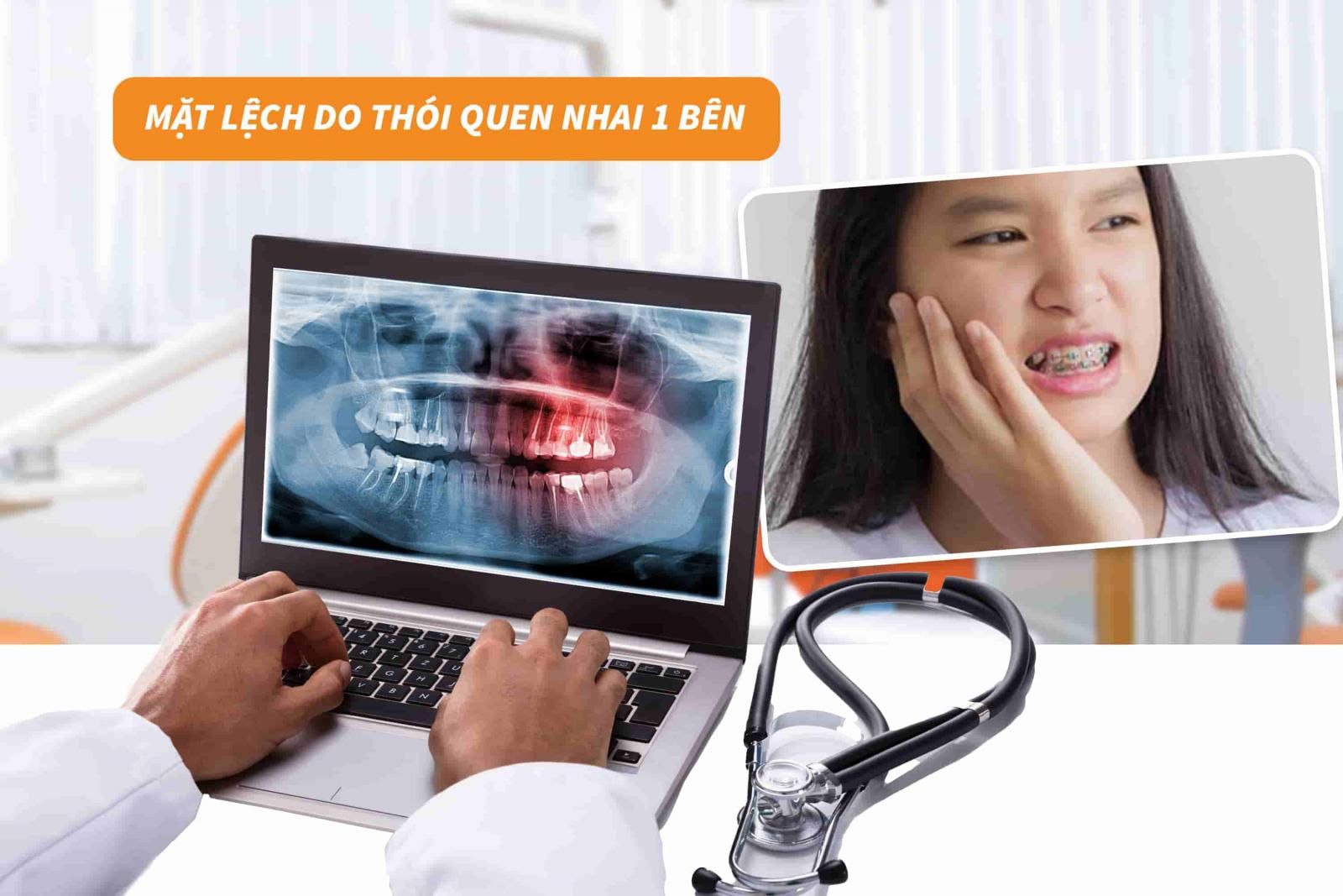 Mặt lệch do thói quen nhai 1 bên