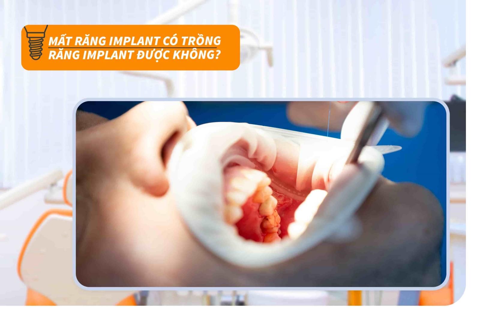 Mất răng Implant có trồng răng Implant được không?