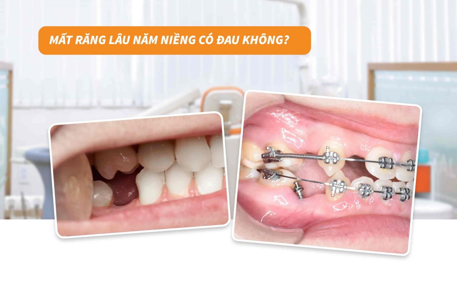 Mất răng lâu năm niềng có đau không?