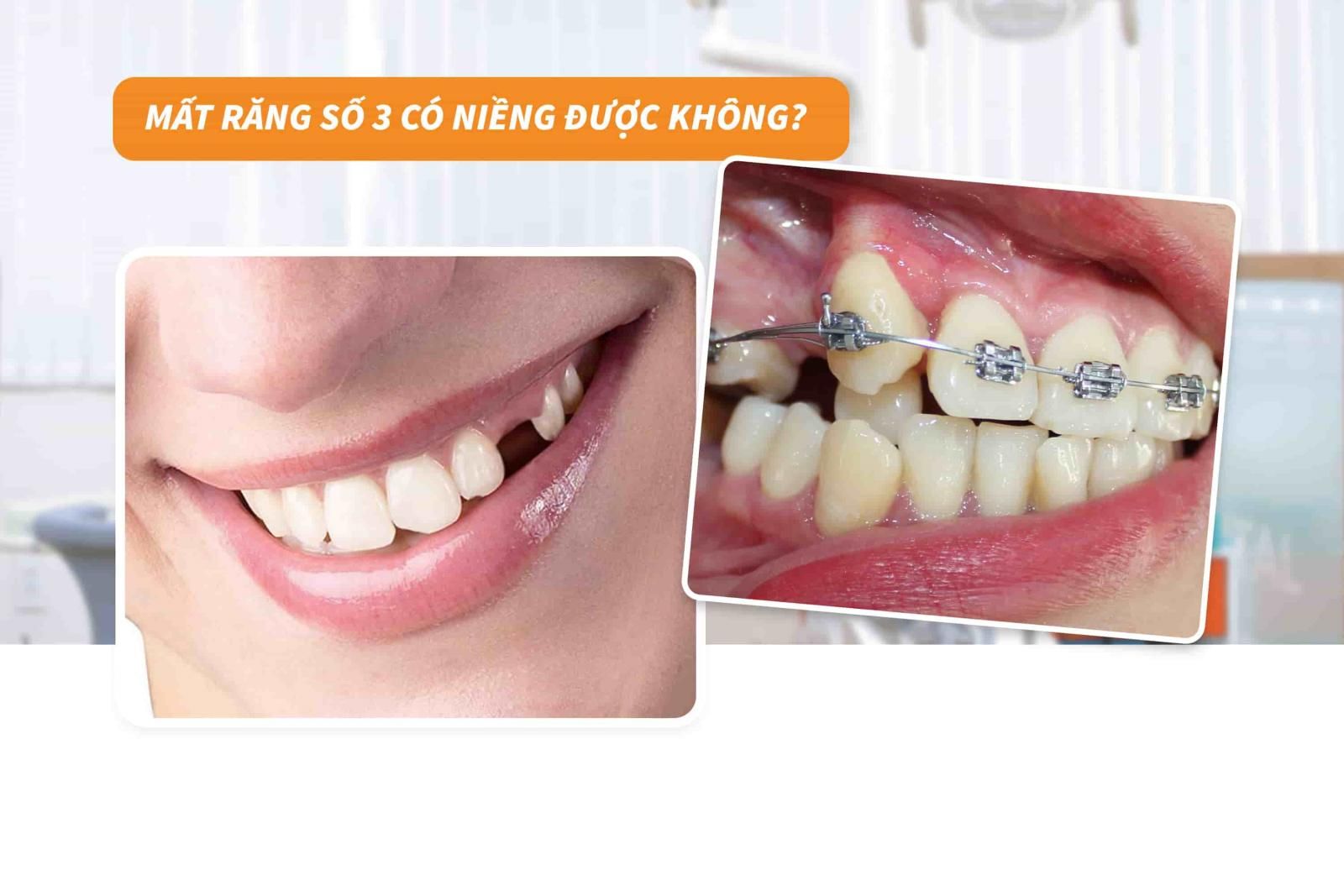 Mất răng số 3 có niềng được không