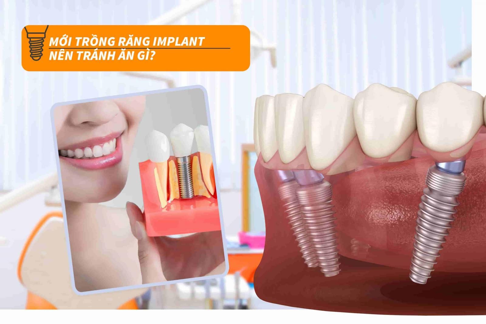 Mới trồng răng Implant nên tránh ăn gì?