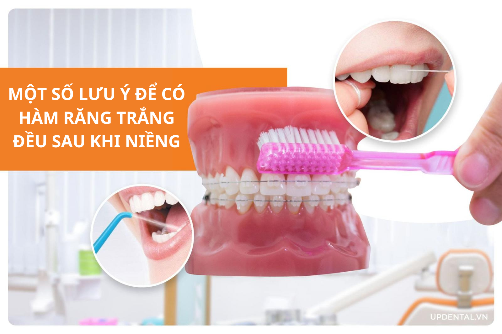 Một số lưu ý để có hàm răng trắng đều sau khi niềng