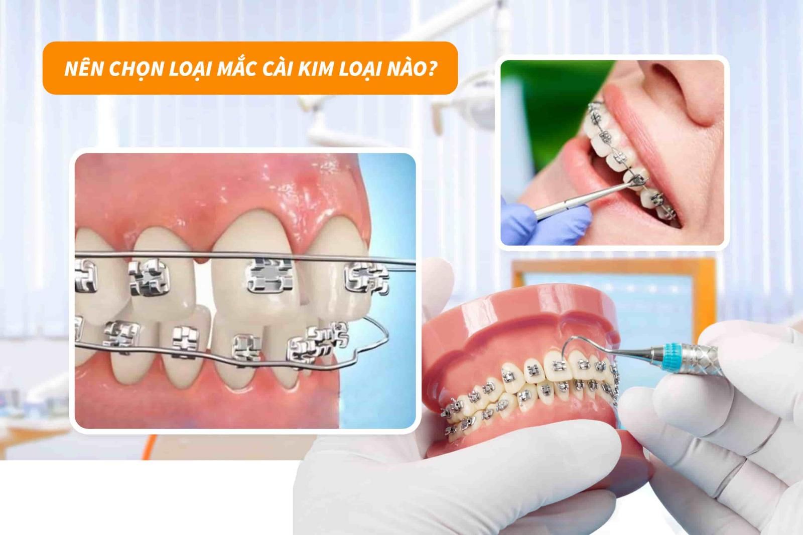 Nên chọn loại mắc cài kim loại nào?