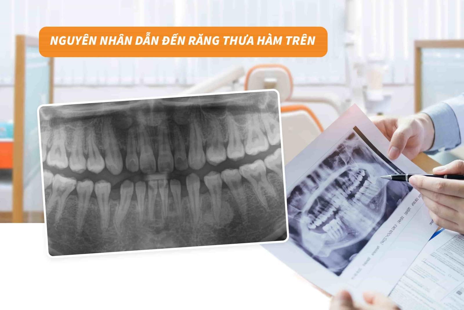 Nguyên nhân dẫn đến răng thưa hàm trên