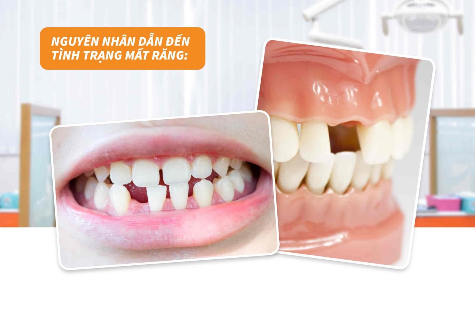 Nguyên nhân dẫn đến tình trạng mất răng