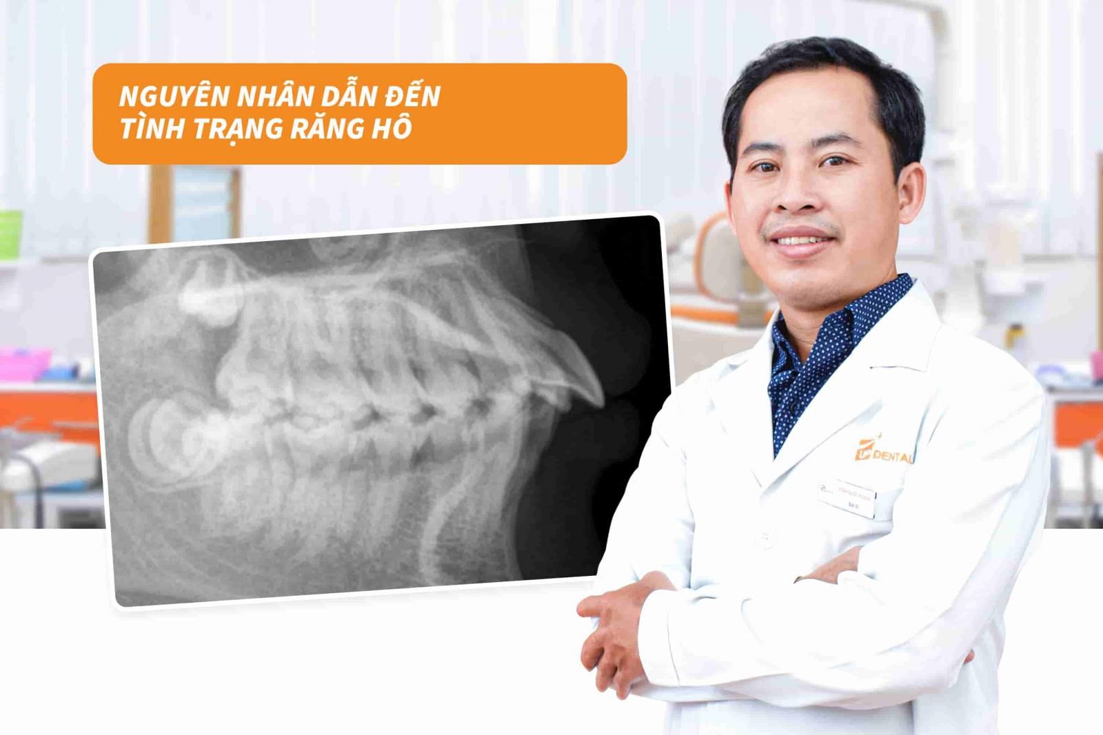 Nguyên nhân dẫn đến tình trạng răng hô