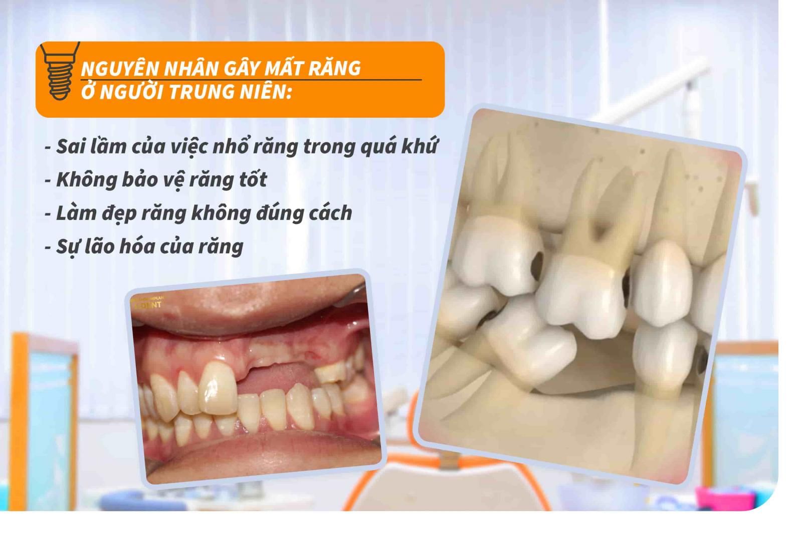 Nguyên nhân gây mất răng ở người trung niên