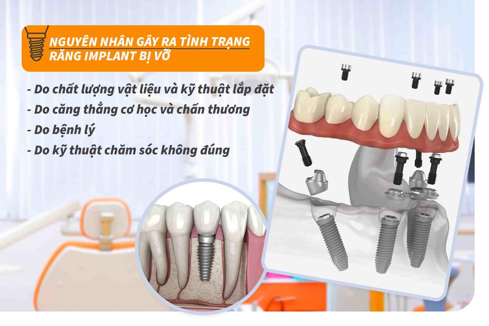 Nguyên nhân gây ra tình trạng răng Implant bị vỡ