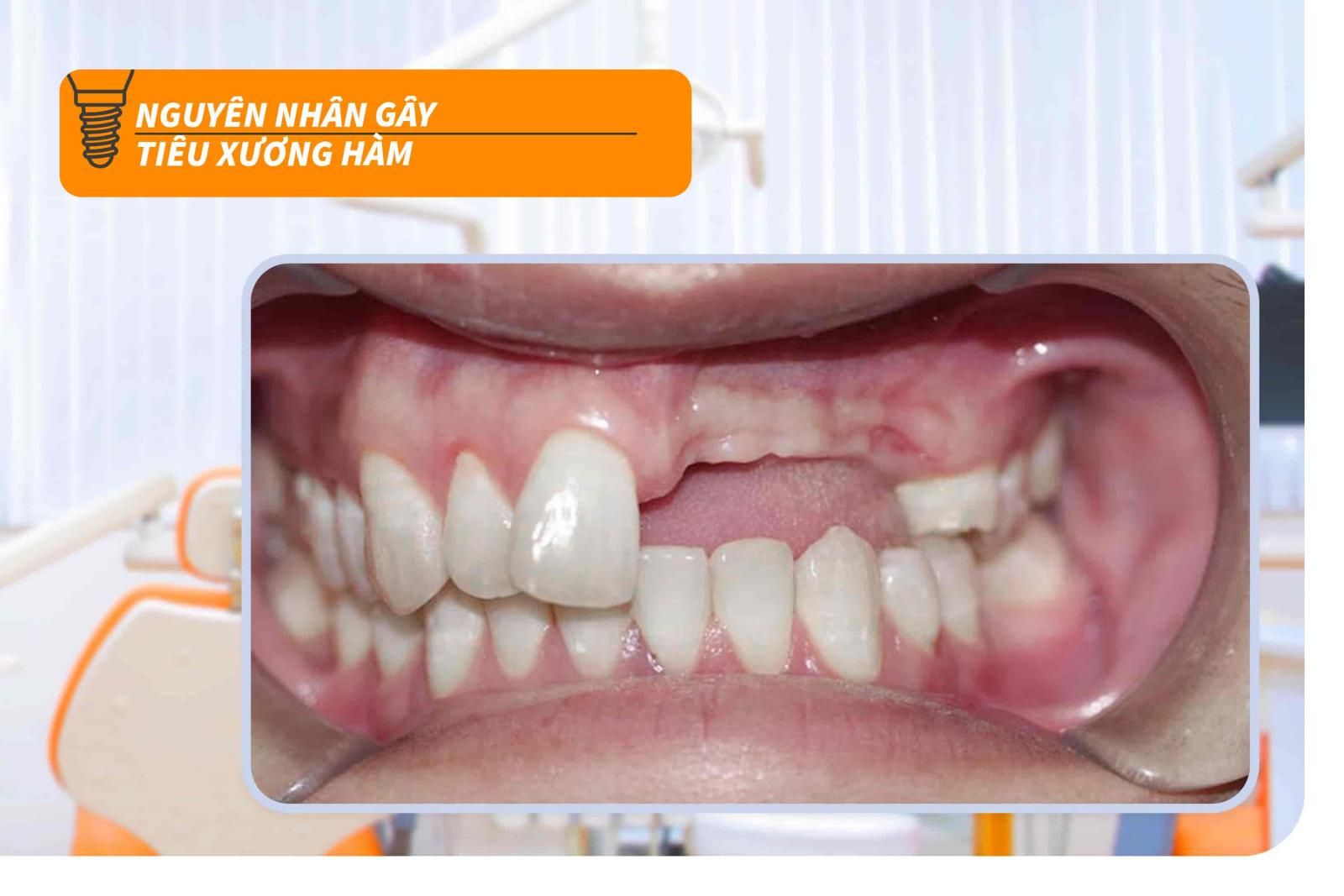 Nguyên nhân gây tiêu xương hàm