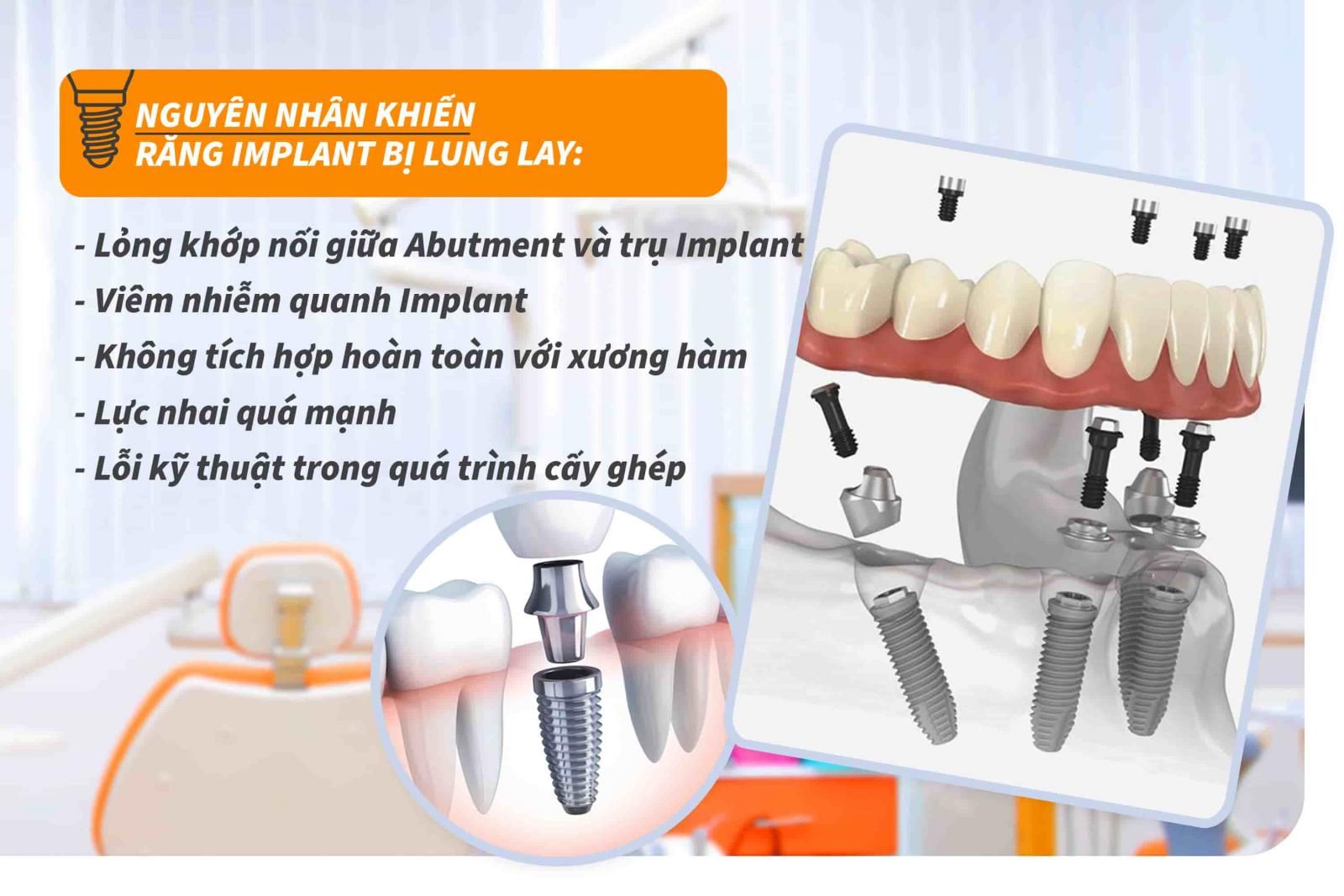 Nguyên nhân khiến răng Implant bị lung lay