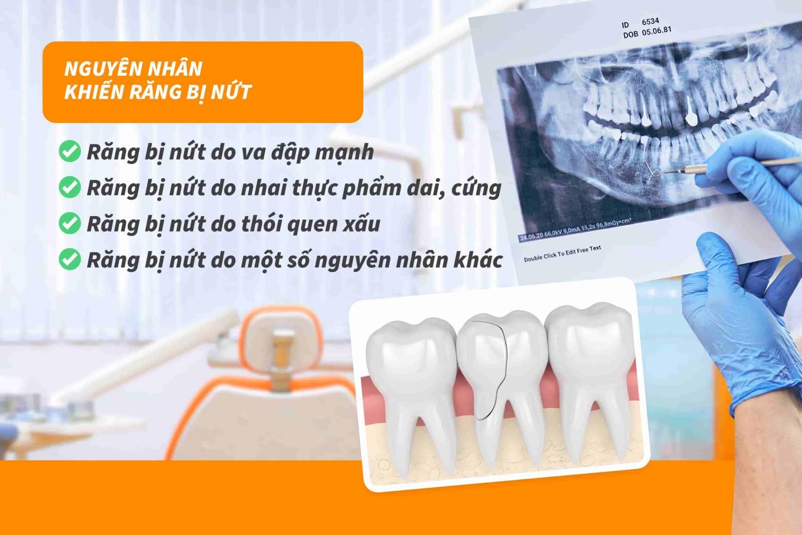 Nguyên nhân khiến răng bị nứt