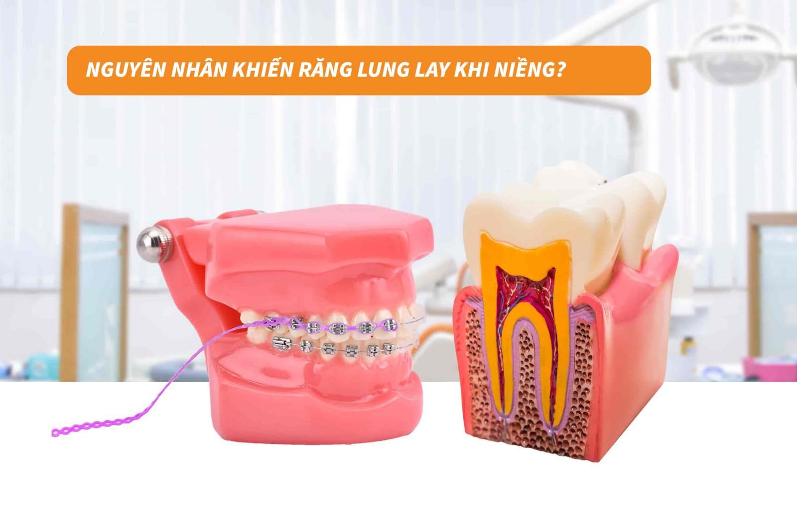 Nguyên nhân khiến răng lung lay khi niềng