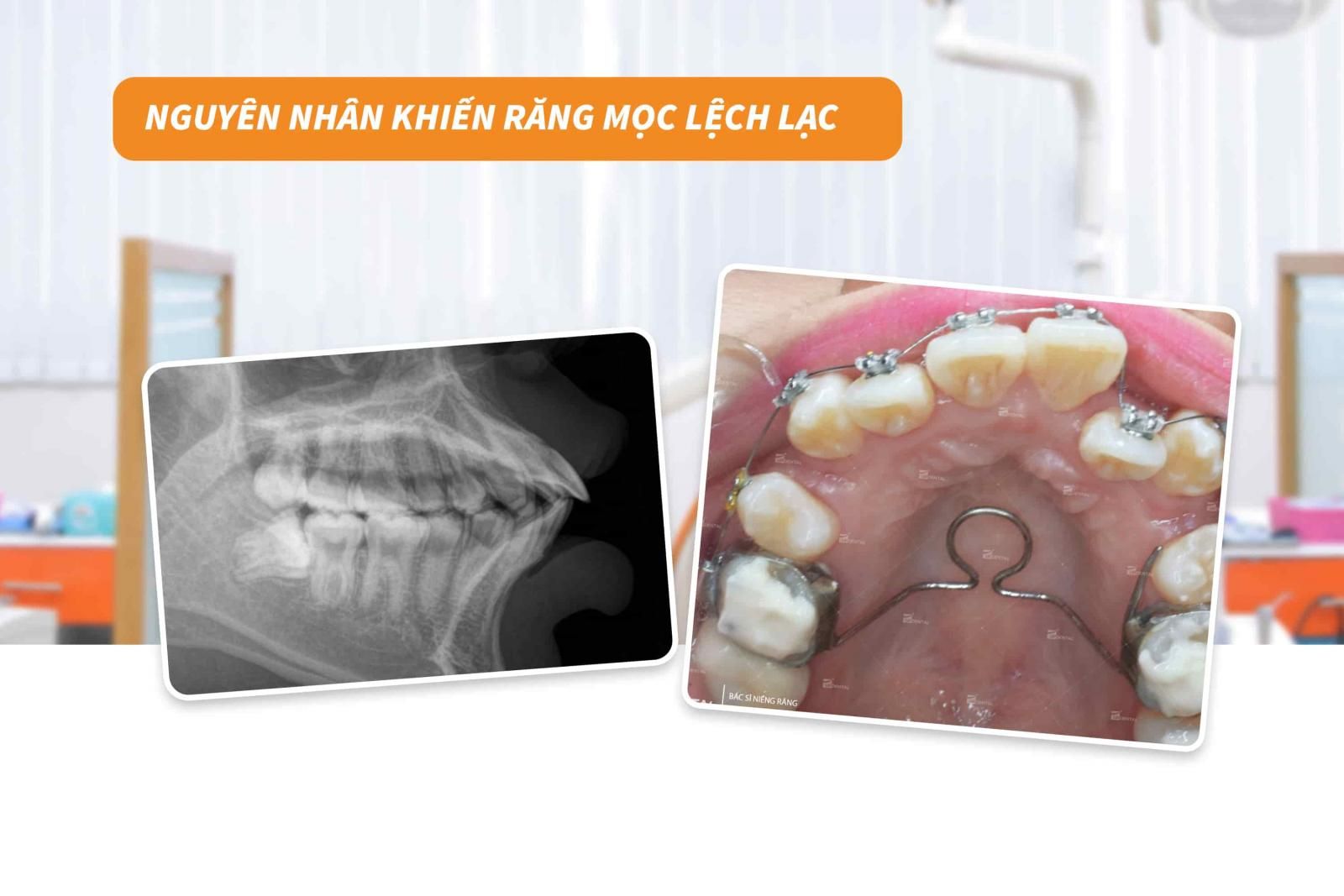 Nguyên nhân khiến răng mọc lệch lạc