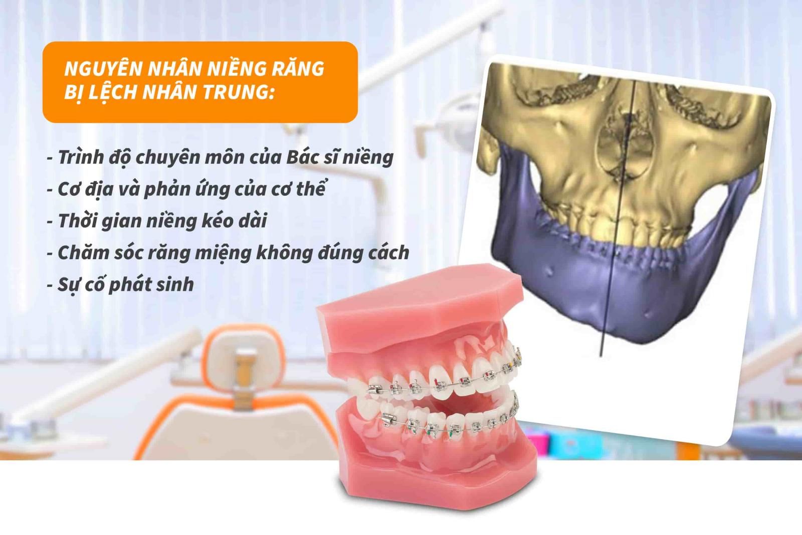 Nguyên nhân niềng răng lệch nhân trung