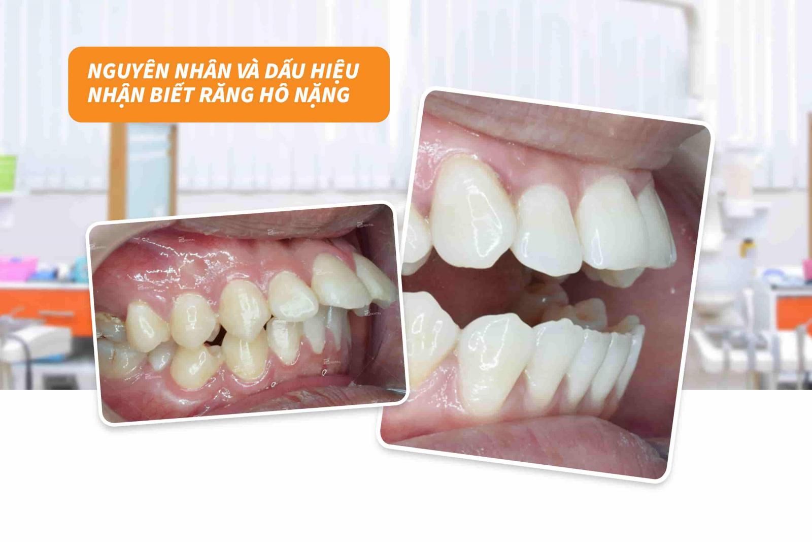 Nguyên nhân và dấu hiệu nhận biết răng hô nặng