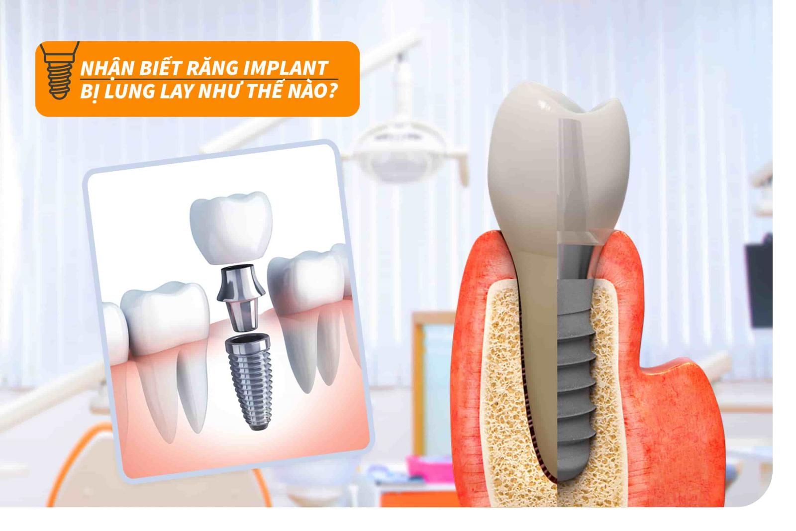 Nhận biết răng Implant bị lung lay như thế nào?