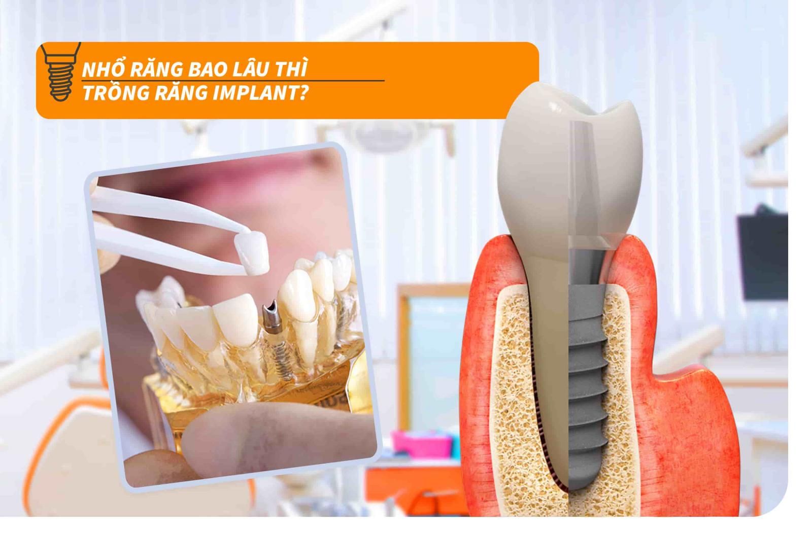 Nhổ răng bao lâu thì trồng răng Implant