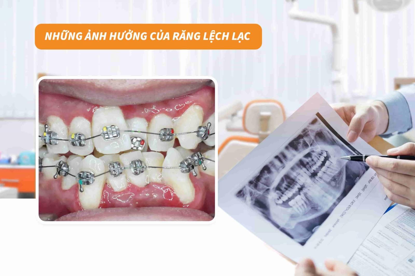 Những ảnh hưởng của răng lệch lạc