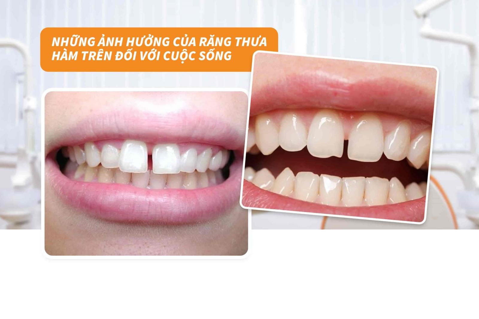 Những ảnh hưởng của răng thưa đối với cuộc sống