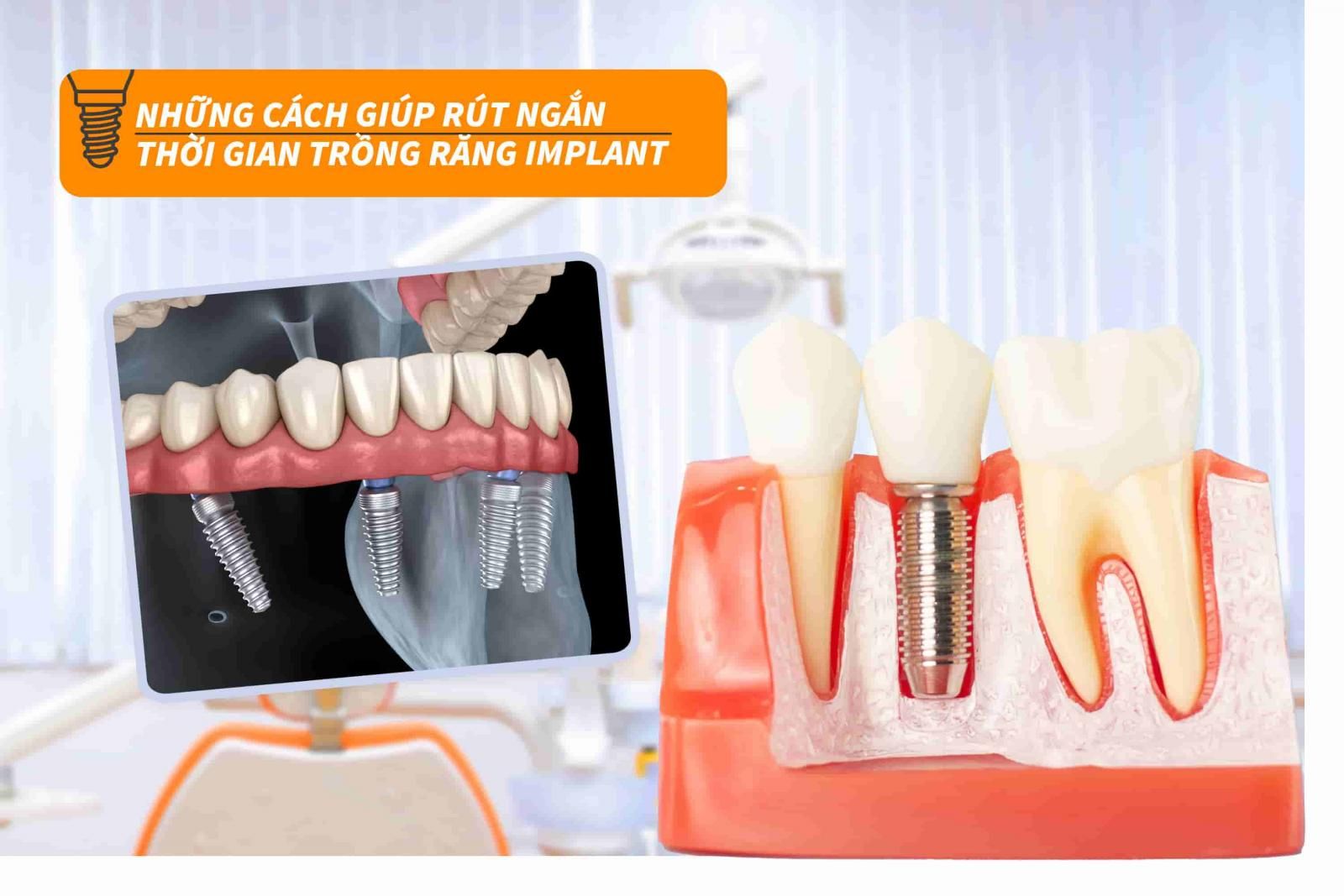 Những cách rút ngắn thời gian trồng răng Implant