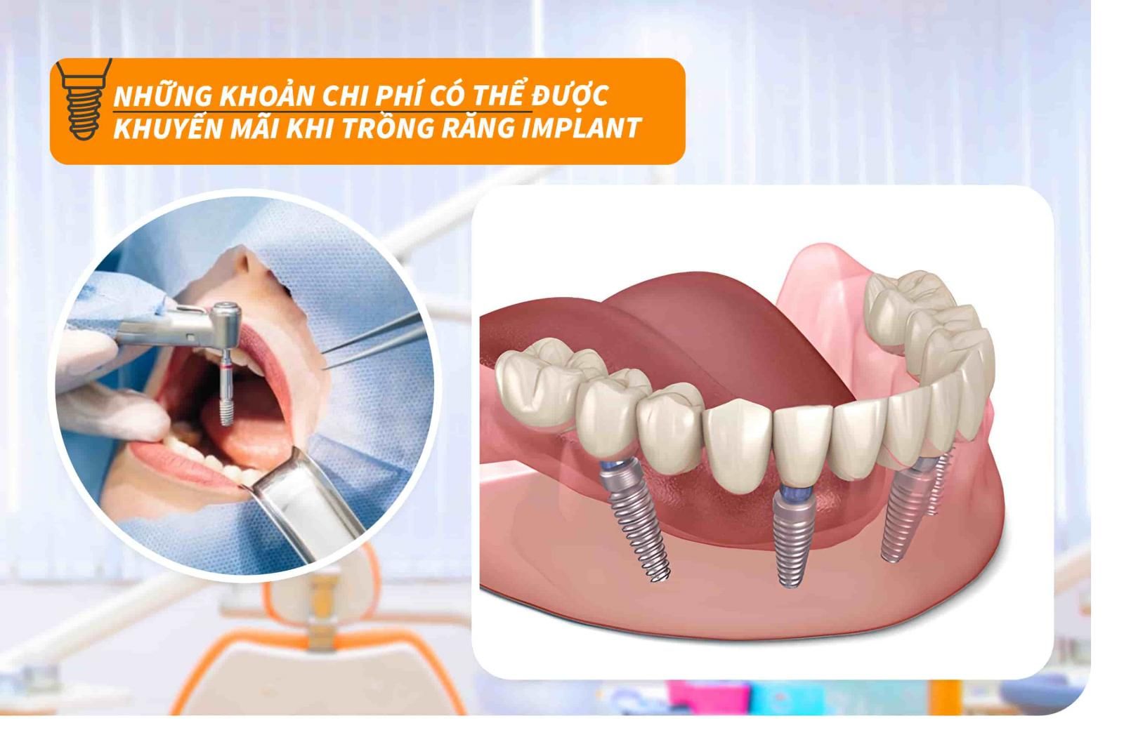 Những khoản chi phí có thể được khuyến mãi khi trồng răng Implant