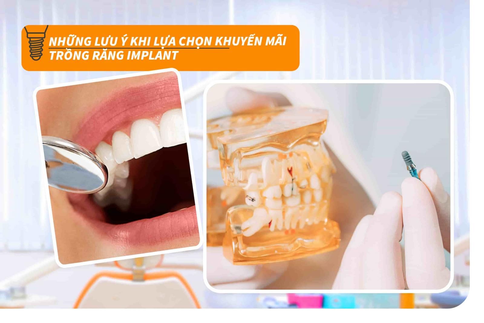 Những lưu ý khi lựa chọn khuyến mãi trồng răng Implant