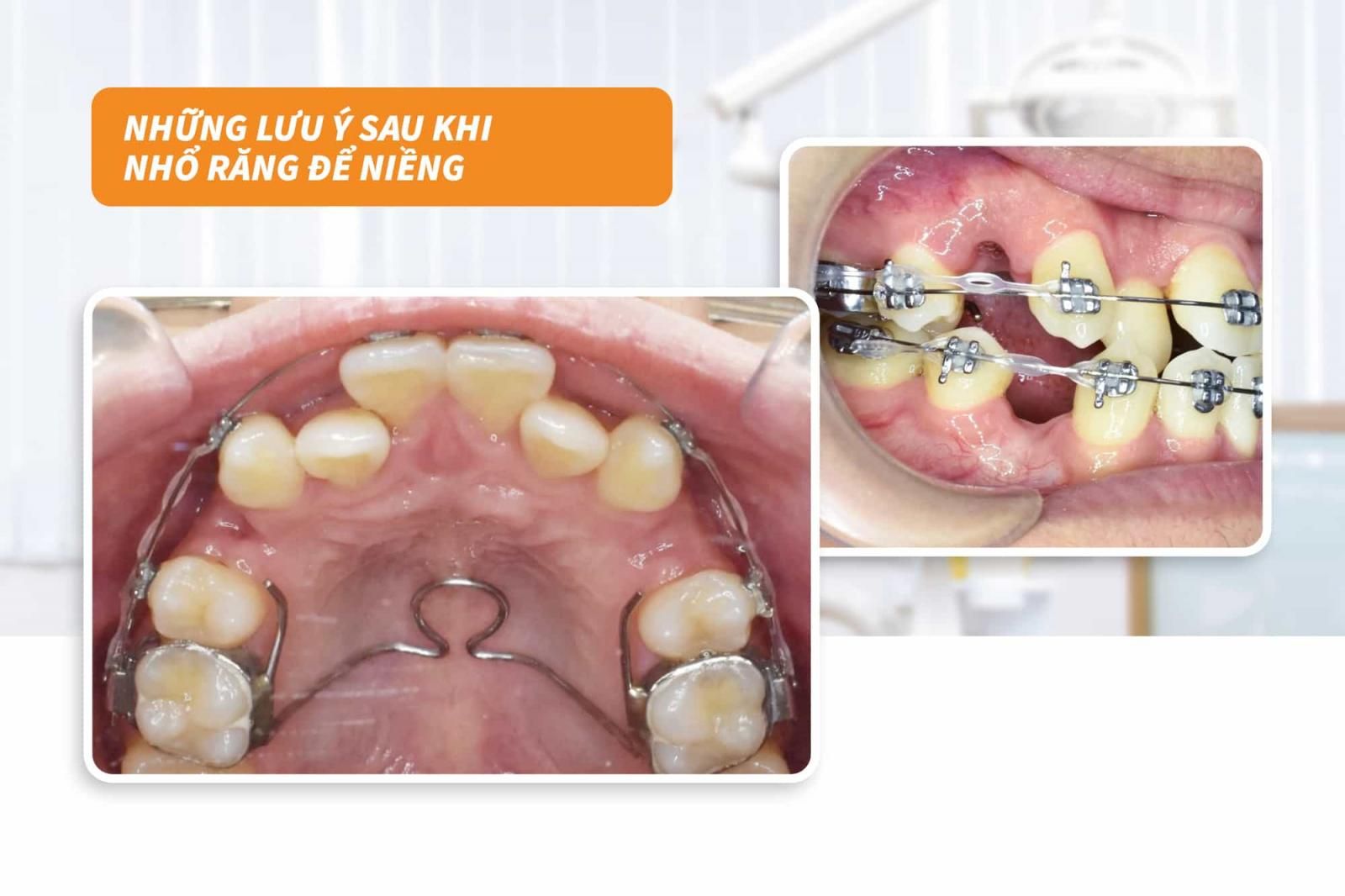 Những lưu ý sau khi nhổ răng để niềng