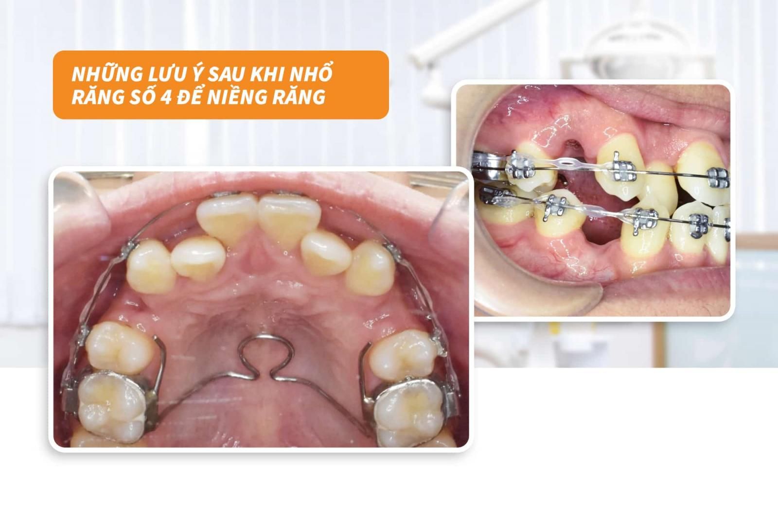 Những lưu ý khi nhổ răng số 4 để niềng