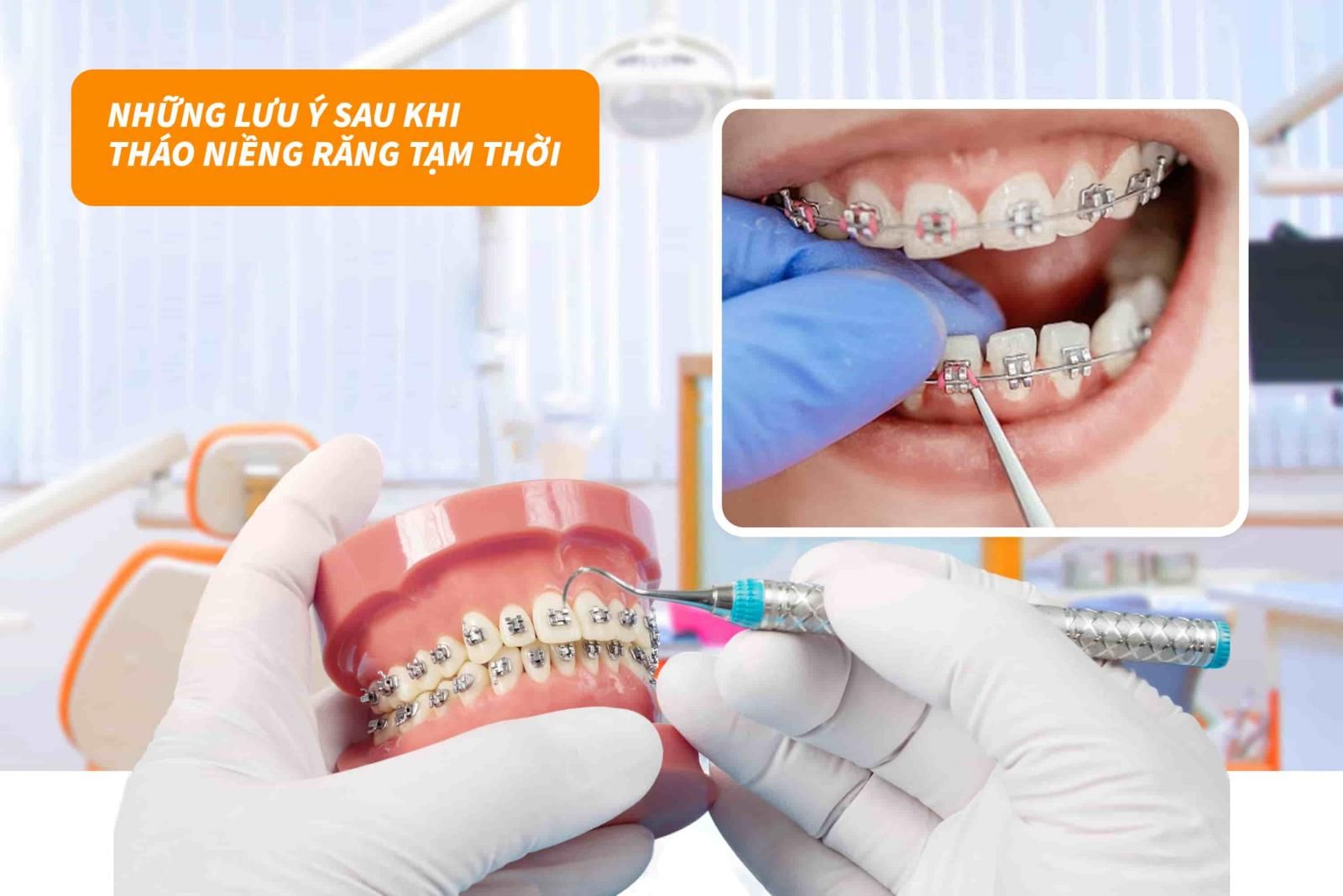 Những lưu ý sau khi tháo niềng răng tạm thời