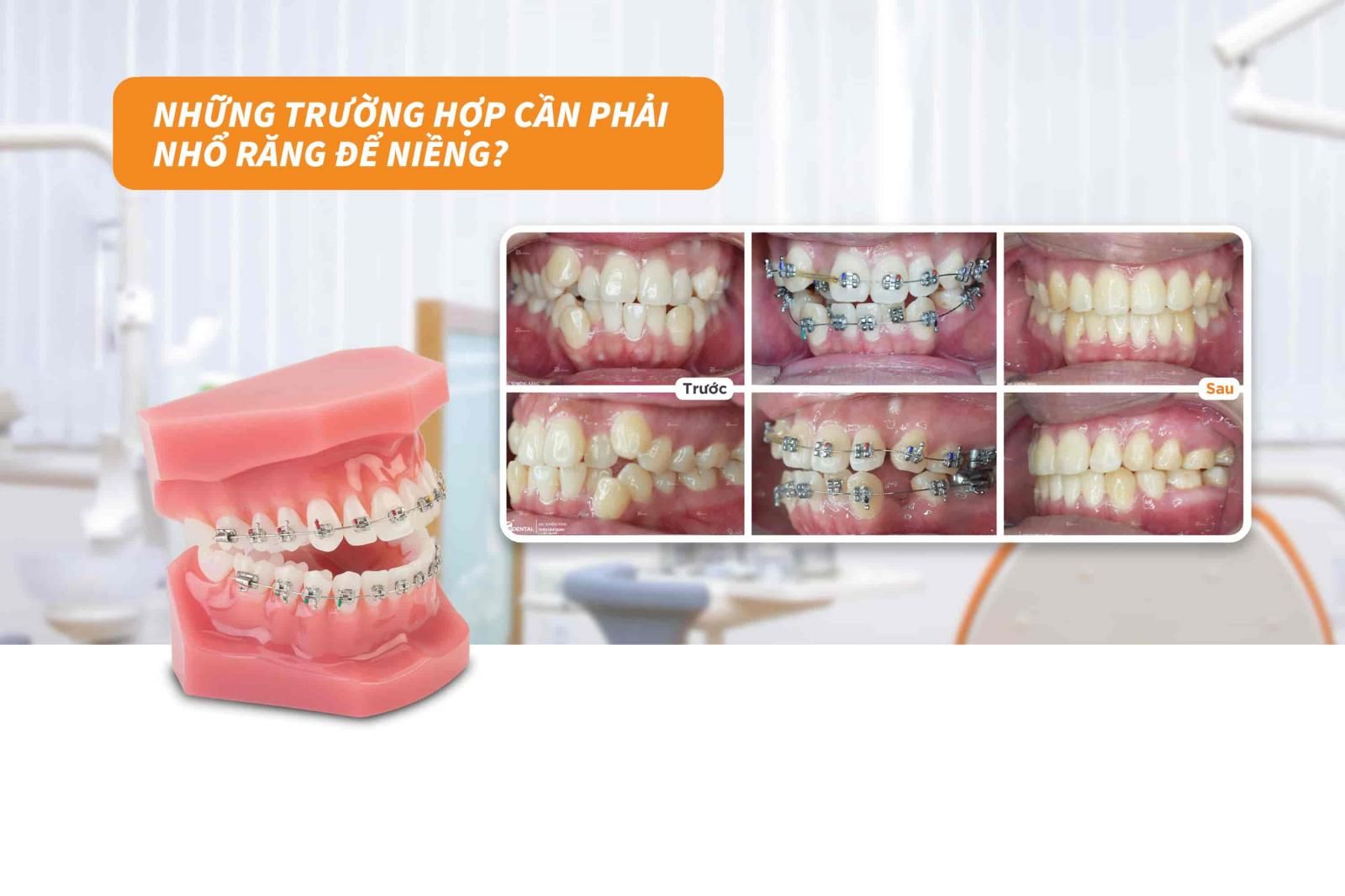 Những trường hợp cần phải nhổ răng để niềng