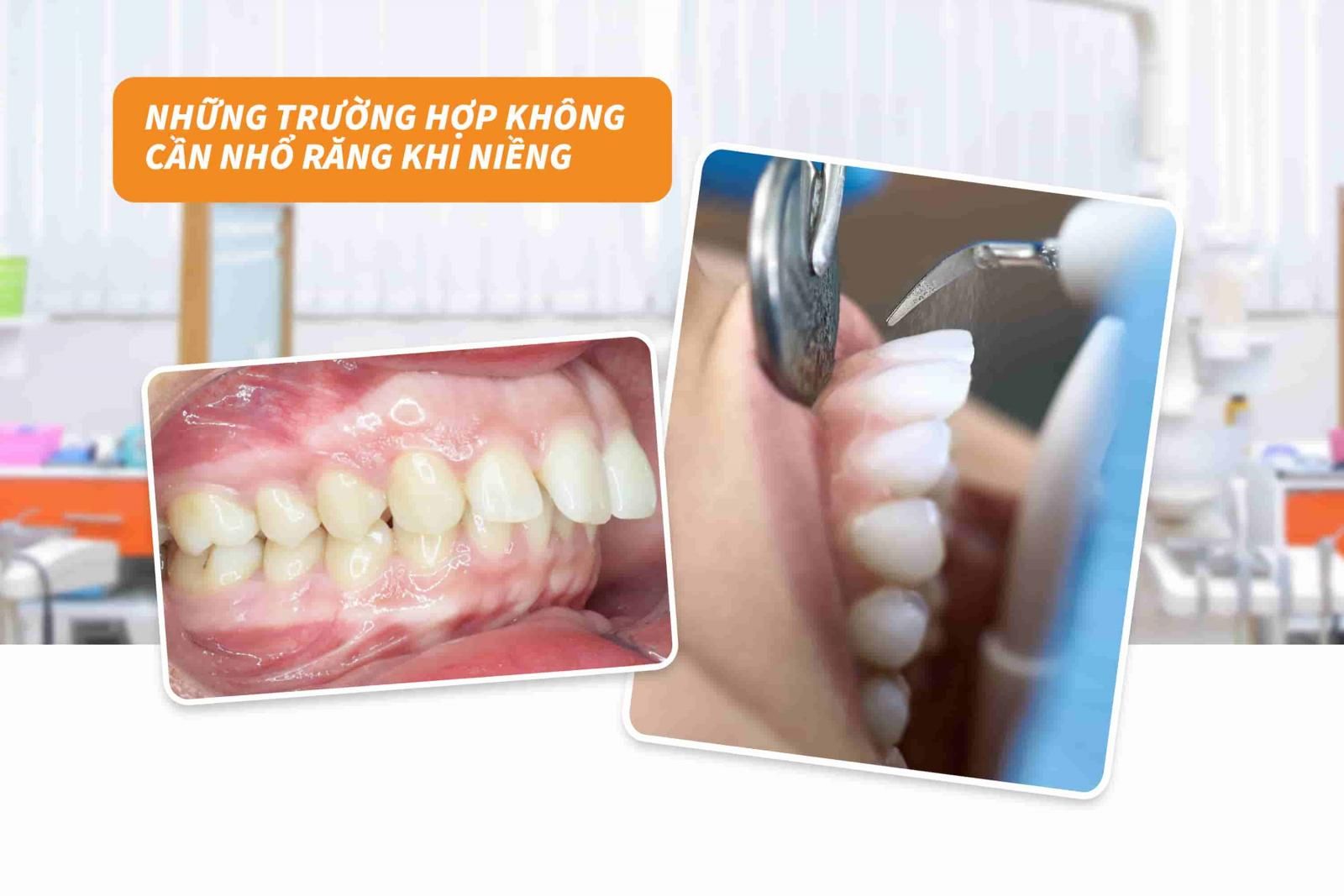 Những trường hợp niềng răng hô không cần nhổ răng