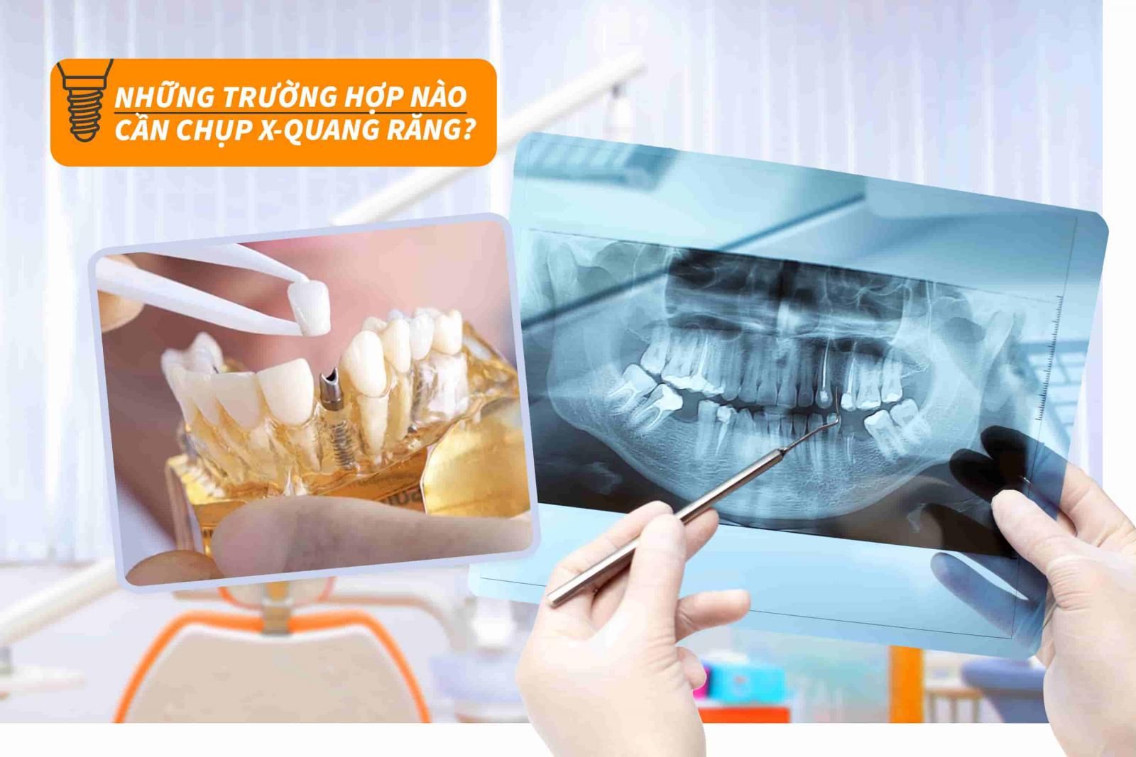 Những trường hợp nào cần chụp X-quang răng